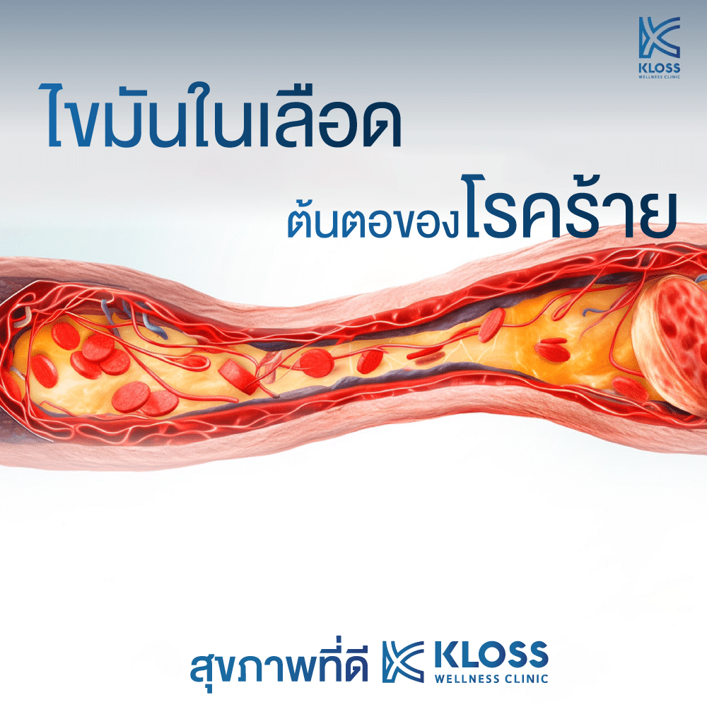 ไขมันในเลือด ต้นตอของโรคร้าย